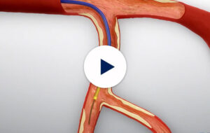 Coronary Interventions - Teleflex - Teleflex Interventional